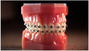 Брекет-система Damon Q