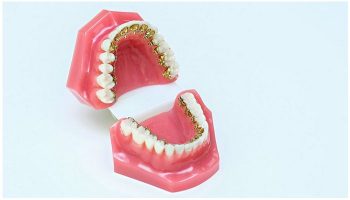 Брекет-система Incognito