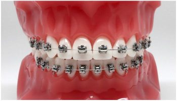 Металлические брекеты H4