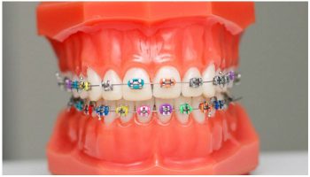 Брекет-системы Victory 3m Unitek