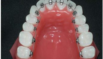 Лингвальные брекеты STB